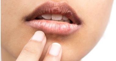 نصائح هامة لتفتيح المناطق الداكنة حول الفم.. للحصول على بشرة موحدة اللون