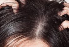 وصفات طبيعية للتخلص من قشرة الشعر .. أبرزها خل التفاح وبذور الحلبة