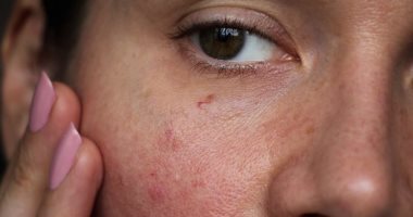5 أشياء تدمر بشرتك بشكل خطير.. منها غسيل الوجه بطريقة خاطئة